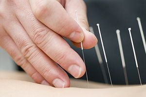 Akupunktur bei Kinderwunsch